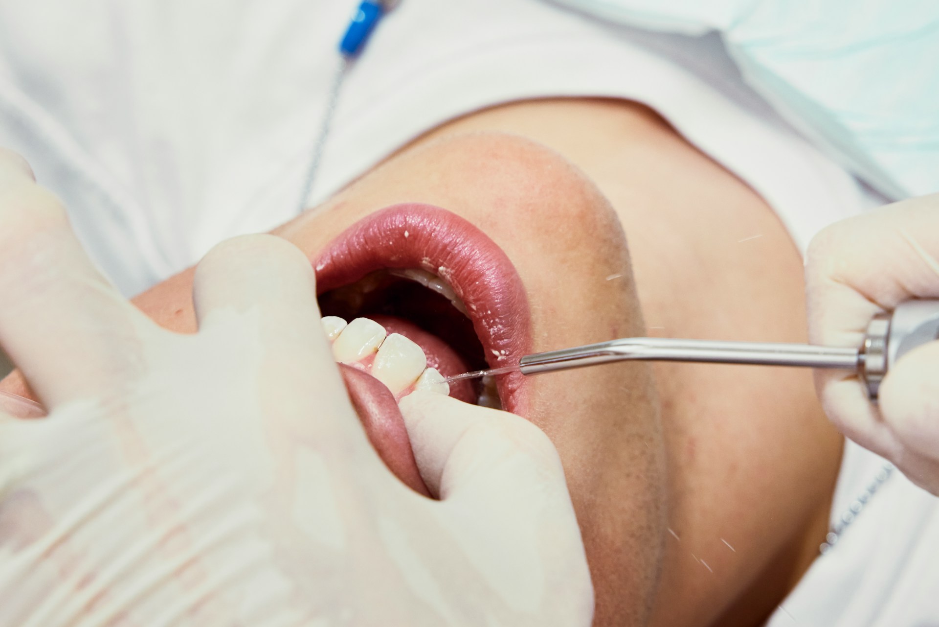 A Closer Look at Scaling and Root Planing: Effective Treatment for Gum Disease