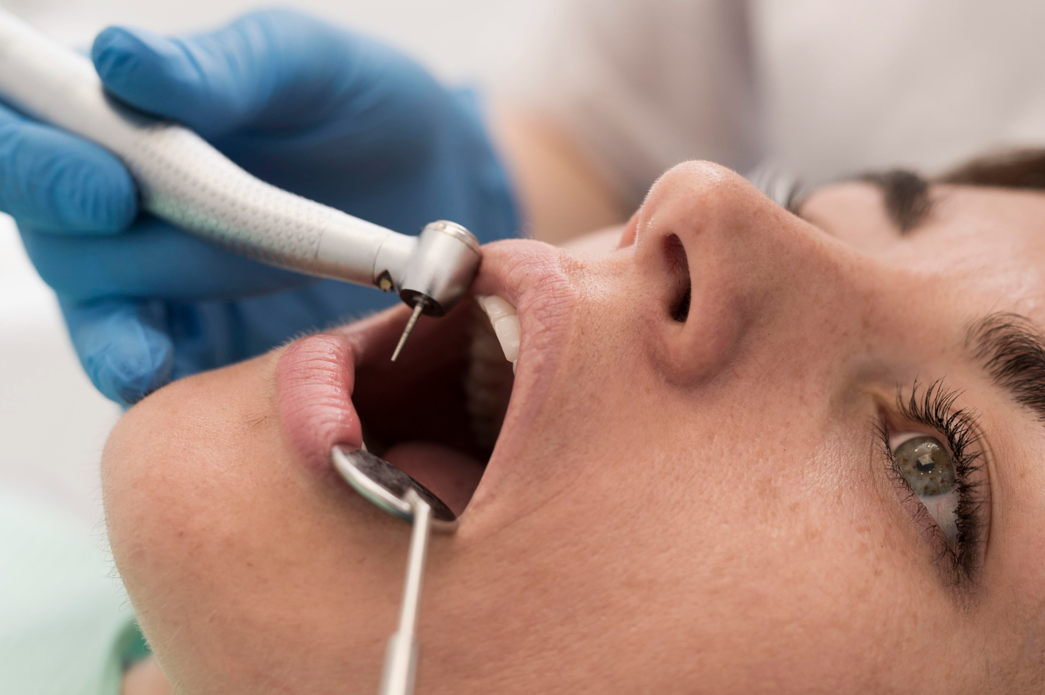 Optimal Oral Health with Scaling and Root Planing