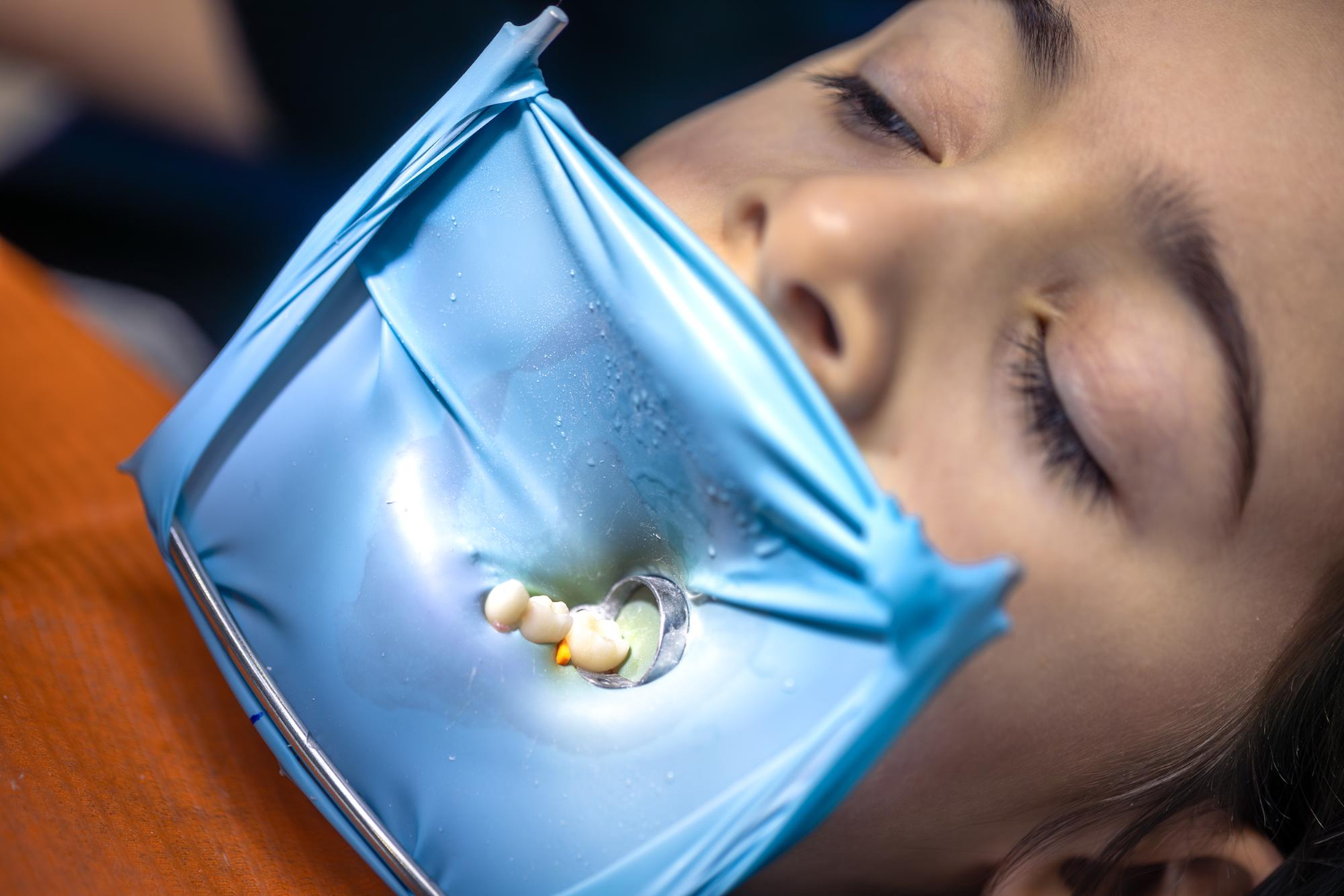 Nitrous Oxide Sedation Eases Dental Anxiety