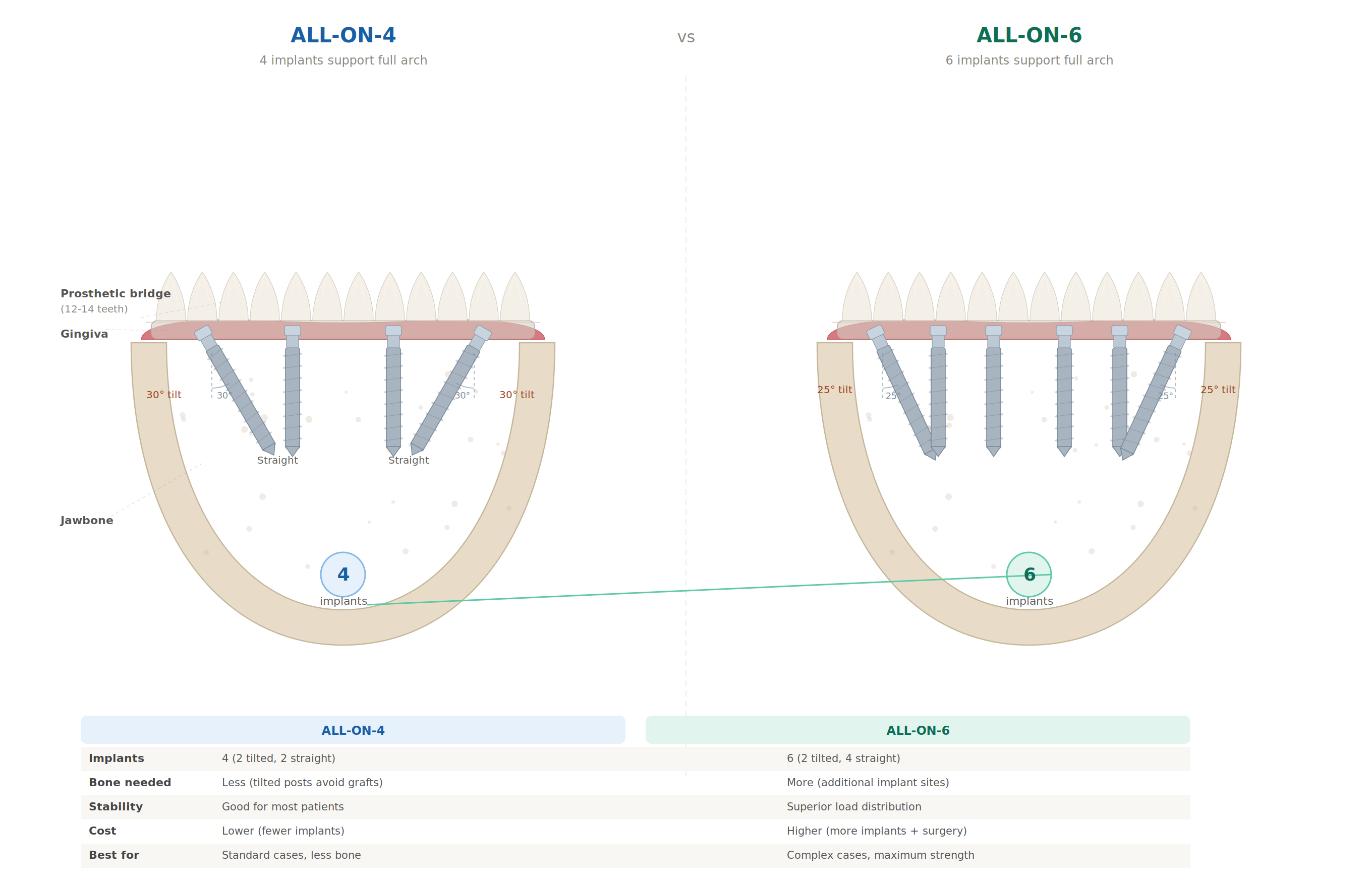 All-on-4 vs All-on-6 Dental Implants Comparison
