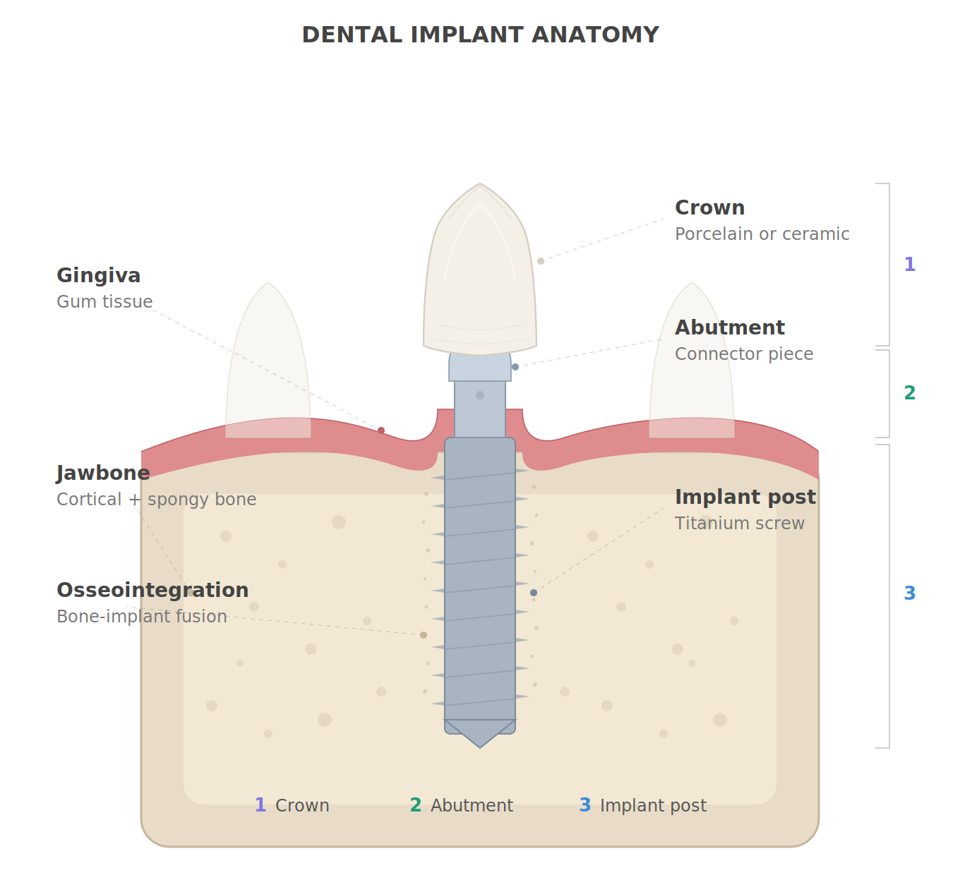 Dental Implant Anatomy
