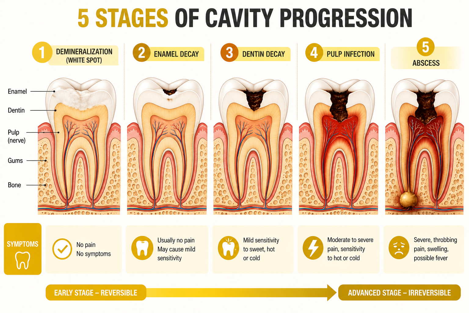 Five stages of early cavity progression diagram showing demineralization enamel decay dentin decay pulp decay and abscess